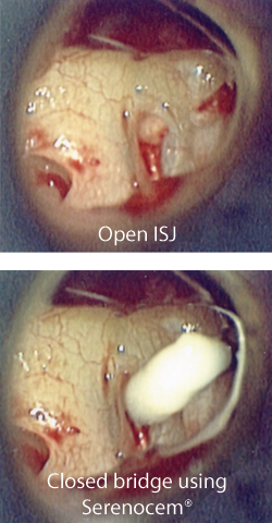 Serenocem™ Otologic Cement from Invotec